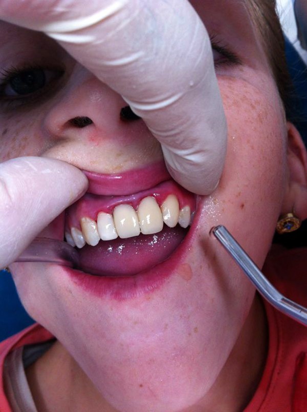 Восстановление зубов  после реставрации