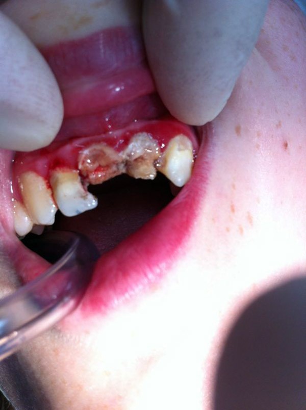 Деффект зубов в следствие  поражённого кариеса