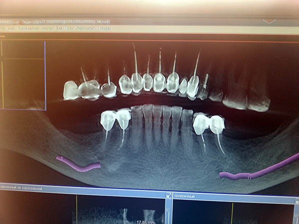 Имплантация зубов является прогрессивным методом восстановления зубного ряда
