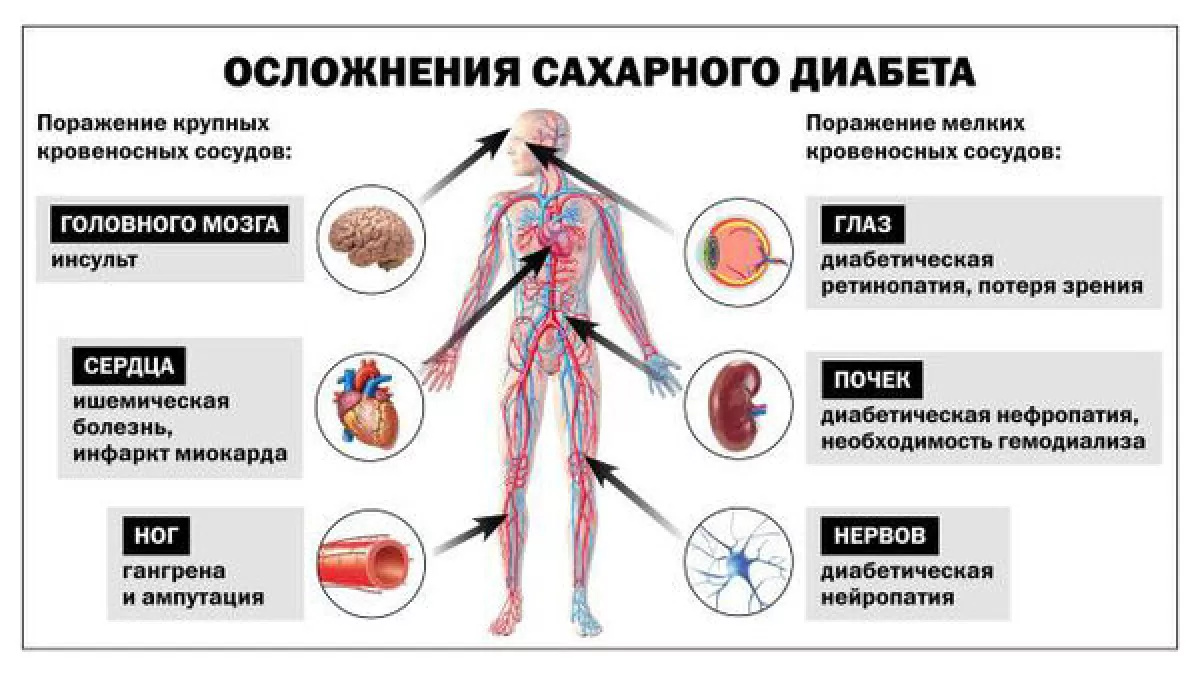 Сахарный диабет