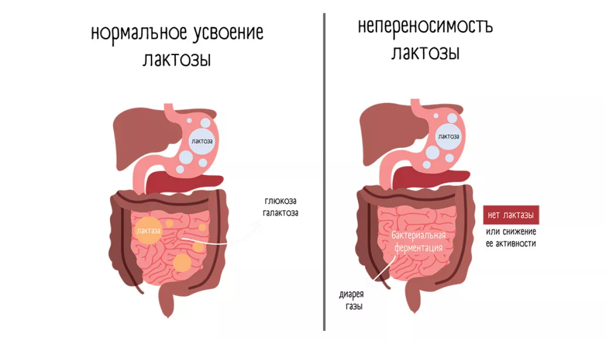Непереносимость лактозы у новорожденных. Непереносимость лактозы у новорожденных симптомы. Признаки непереносимости лактозы. Карта непереносимости лактозы.